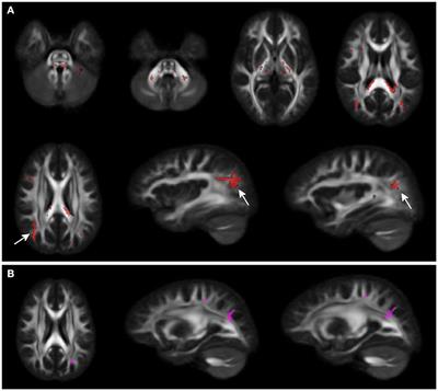 A Different Brain: Anomalies of Functional and Structural Connections in Williams Syndrome